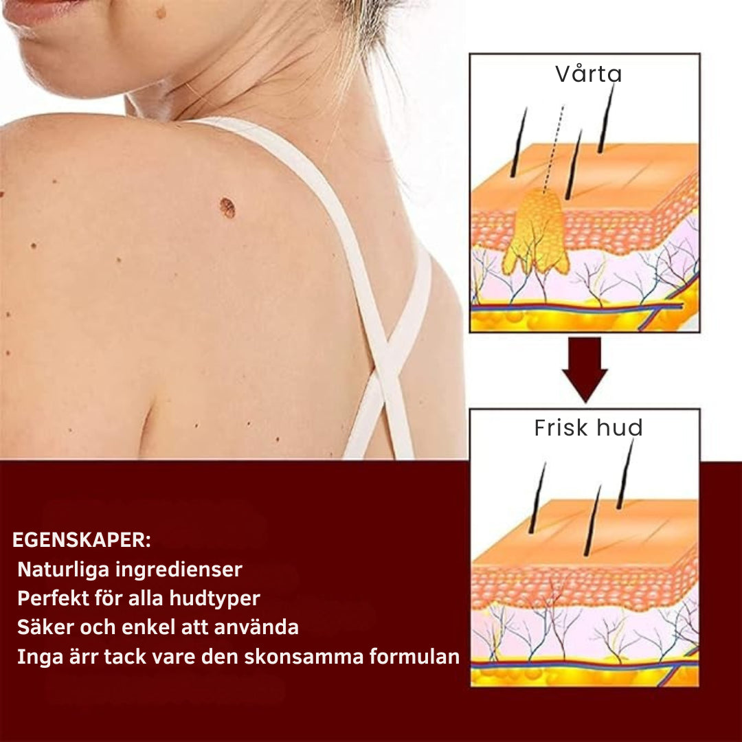 LysterStift™ | Säg Hej Då Till Vårtor och Födelsemärken Med Enkelhet!