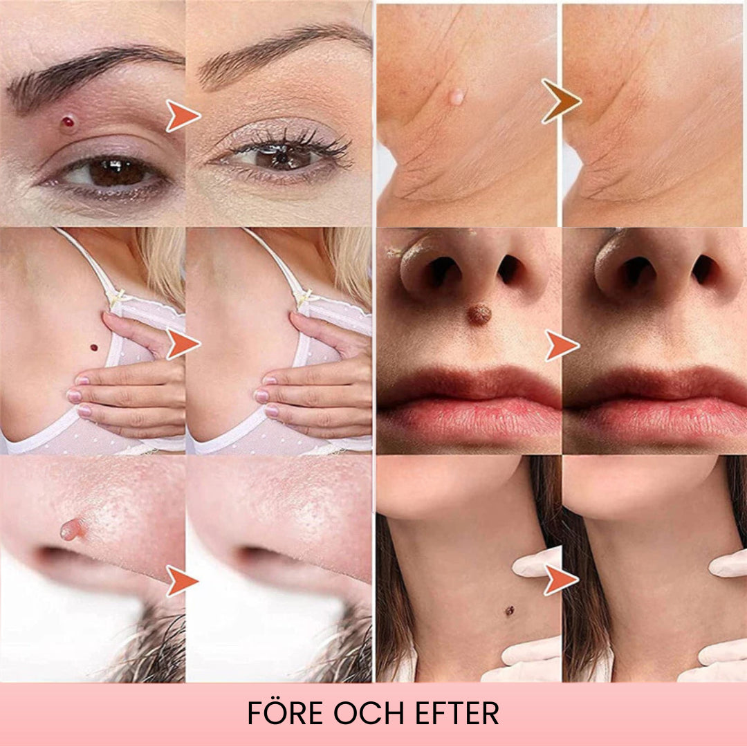 LysterStift™ | Säg Hej Då Till Vårtor och Födelsemärken Med Enkelhet!