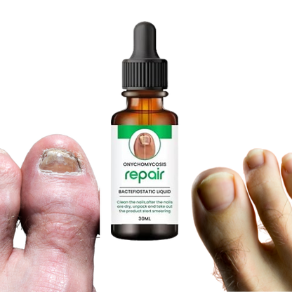 BeautyNails™ Nagelserum | Återställer svampnaglar synligt inom 7 dagar!
